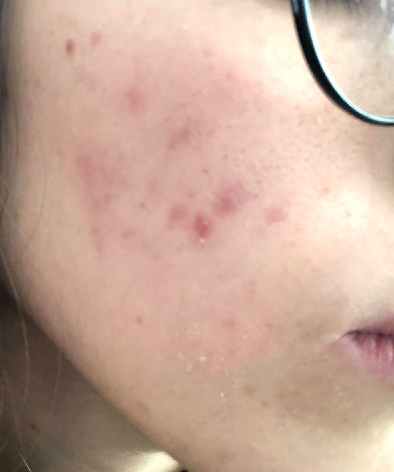 Casos de Acné - Antes y Después de Luz pulsada